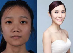 大嘴改小整容前后照片,揭秘整容前后惊人蜕变