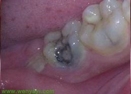 牙根坏了的图片